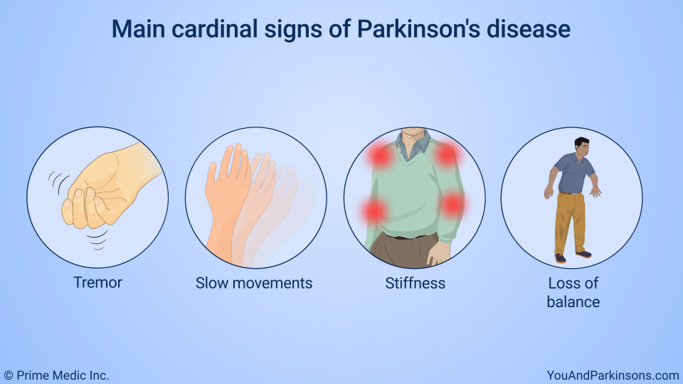 Main cardinal signs of Parkinson's disease