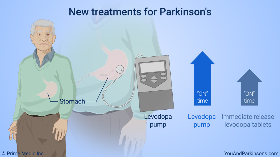 New treatments for Parkinson's