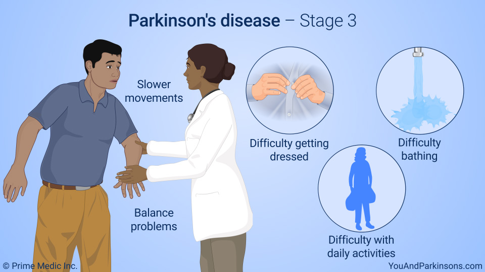 Parkinson's disease – Stage 3