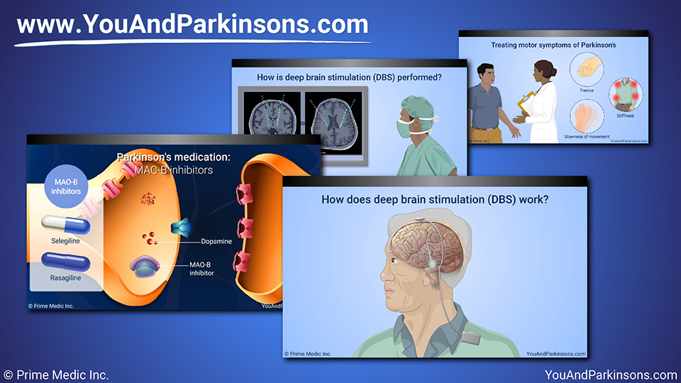 Slide Show - Treatment and Management of Parkinson’s Disease