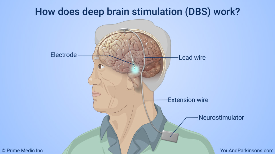 How does deep brain stimulation (DBS) work?