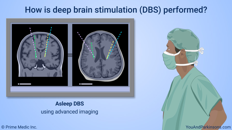 How is deep brain stimulation (DBS) performed?