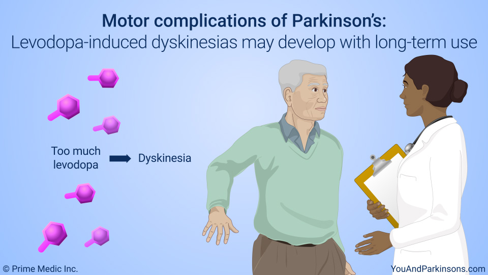 Motor complications of PD: Levodopa induced dyskinesia may develop with long-term use of levodopa