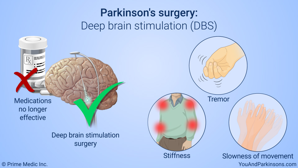 Parkinson's surgery: Deep brain stimulation (DBS)