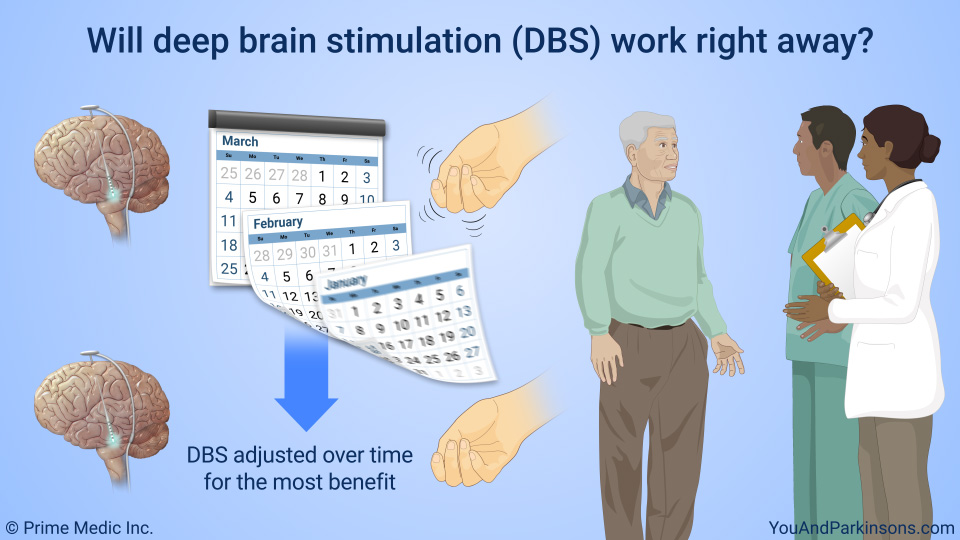 Will deep brain stimulation (DBS) work right away?