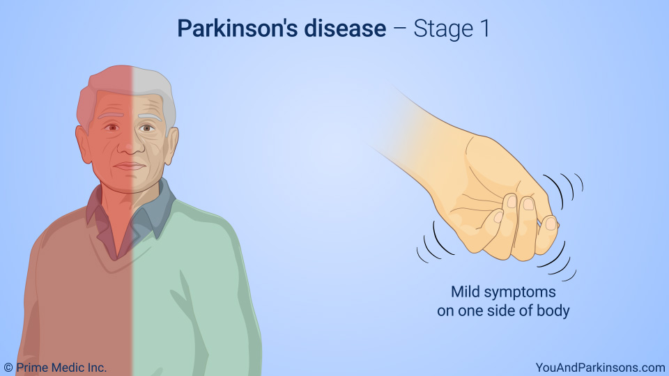 Parkinson's disease – Stage 1