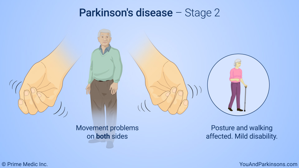 Parkinson's disease – Stage 2