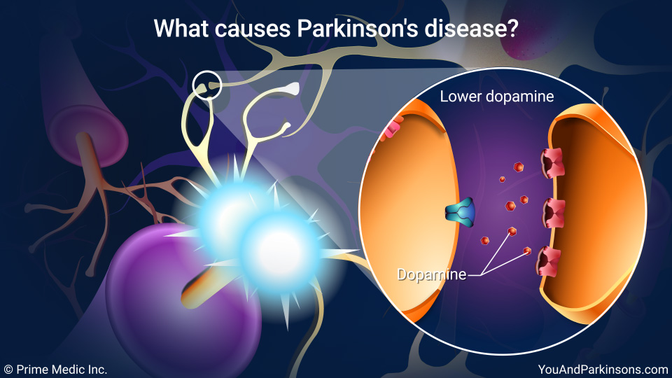 What causes Parkinson's disease?